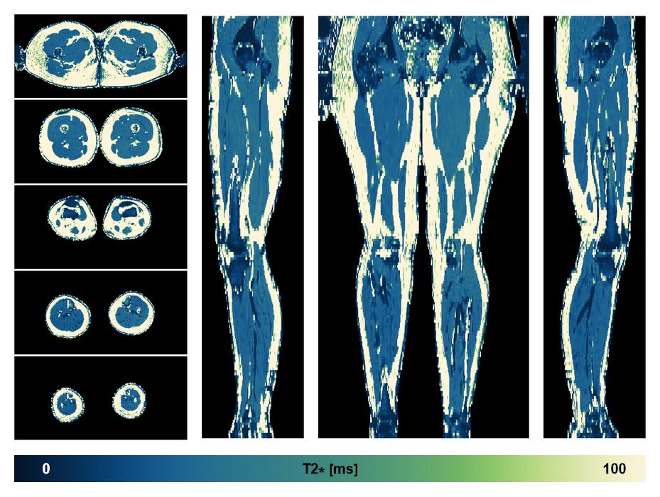 The T2 star relaxation time of the lower extremity obtained from the dixon reconstruction for muscle water fat quantification.